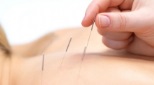 Despre Acupunctura