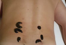 Medic Acupunctura Brasov Cabinet de acupunctura Brasov - HRIADA THERAPY - Dr. Hrihor Adrian