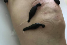 Medic Acupunctura Brasov Cabinet de acupunctura Brasov - HRIADA THERAPY - Dr. Hrihor Adrian