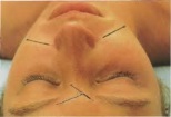 Medic Acupunctura Sibiel Acupunctura Medias